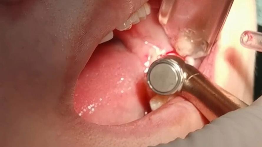 视频微创拨牙方法究竟是什么？它与传统拨牙相比有哪些独特优势，又适合哪些口腔问题呢？-图1