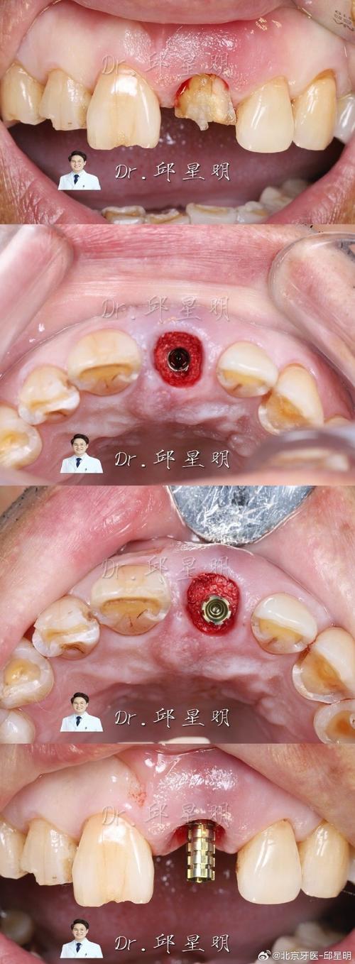 种牙种植体愈效果-图3 种牙种植体愈效果-图3