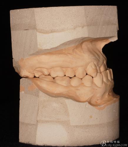 侧切牙存在间隙或扭转时，是应该先通过正畸矫正，还是直接做烤瓷牙修复更合适？-图2