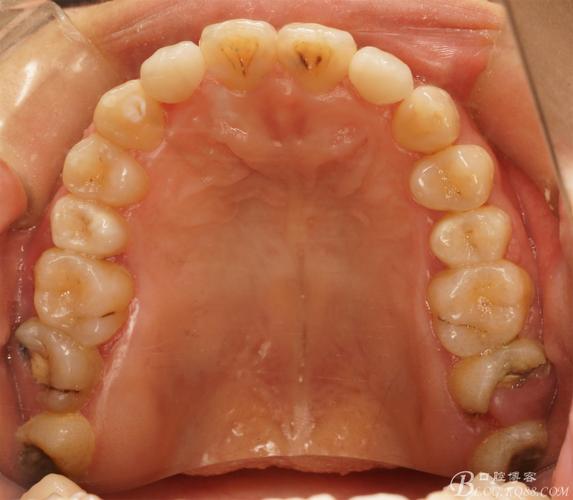 侧切牙存在间隙或扭转时，是应该先通过正畸矫正，还是直接做烤瓷牙修复更合适？-图1