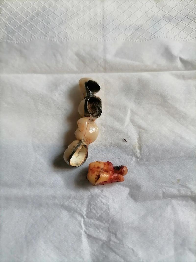 侧切牙存在间隙或扭转时,是应该先通过正畸矫正,还是直接做烤瓷牙修复更合适?-图3 侧切牙存在间隙或扭转时,是应该先通过正畸矫正,还是直接做烤瓷牙修复更合适?-图3