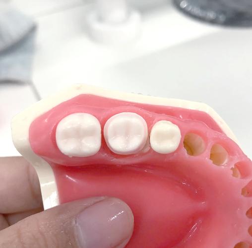 牙体预备定深方法有哪些常见类型?不同修复体类型(如全冠、嵌体)如何选择最优定深策略以确保边缘适配性与牙髓安全?-图3 牙体预备定深方法有哪些常见类型?不同修复体类型(如全冠、嵌体)如何选择最优定深策略以确保边缘适配性与牙髓安全?-图3