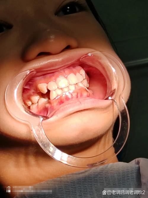 12岁孩子正畸时，拔牙是必须步骤吗？不拔牙会影响矫正效果或牙齿健康吗？-图3