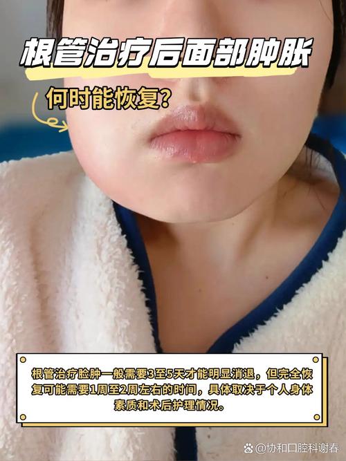 种牙后脸部肿胀怎么办?是正常术后反应还是感染信号?如何正确处理才能避免恶化?-图3 种牙后脸部肿胀怎么办?是正常术后反应还是感染信号?如何正确处理才能避免恶化?-图3