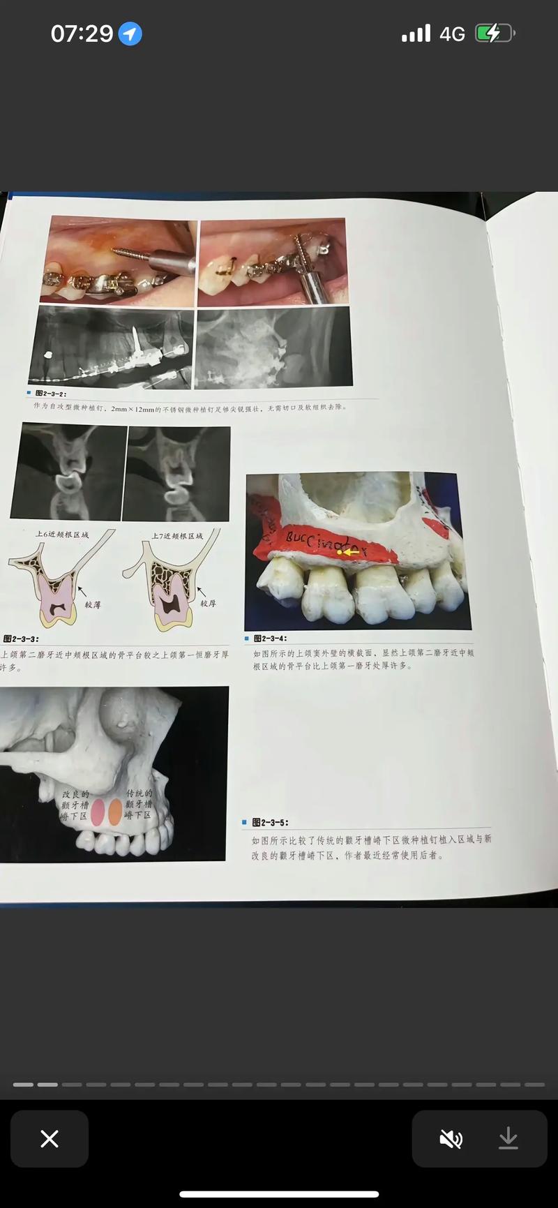 正畸微种植支抗钉究竟有哪些独特优势？相比传统支抗方式效果如何？安全性又该怎样保障？-图1