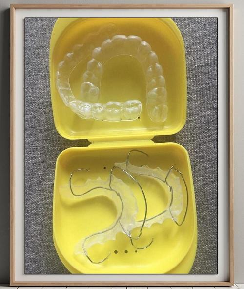 正畸后牙齿保持器图片有什么用？不同类型保持器长这样，看完就知道怎么选了！-图1