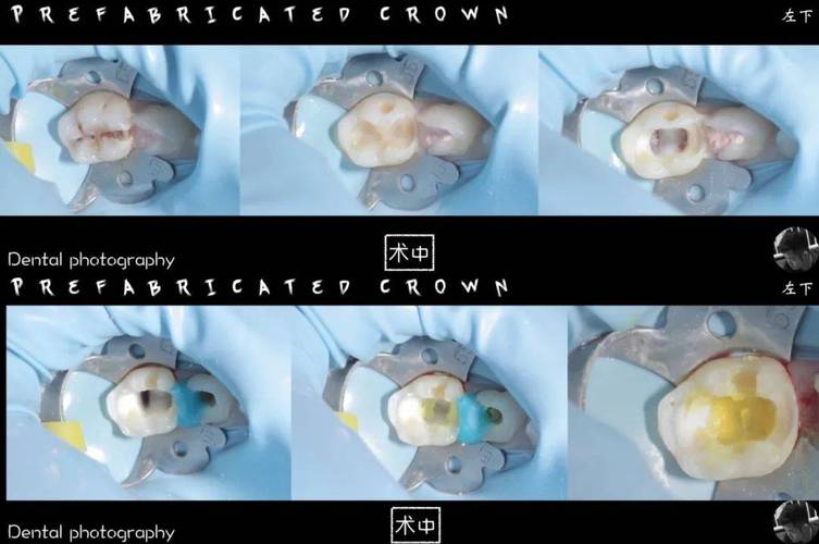 预成冠的制备方法包含哪些关键步骤?不同材料(如不锈钢、树脂)在制备工艺上有何差异,如何优化以适应儿童乳牙的特殊形态?-图1 预成冠的制备方法包含哪些关键步骤?不同材料(如不锈钢、树脂)在制备工艺上有何差异,如何优化以适应儿童乳牙的特殊形态?-图1