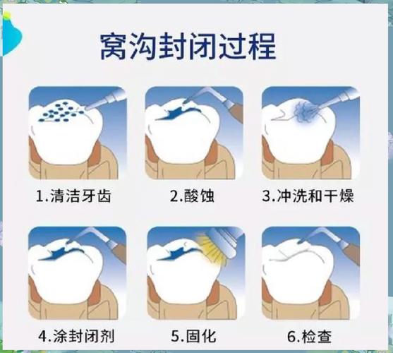 窝沟封闭操作方法的具体步骤是怎样的?操作中如何把握酸蚀时间与光照强度以确保封闭效果?-图1 窝沟封闭操作方法的具体步骤是怎样的?操作中如何把握酸蚀时间与光照强度以确保封闭效果?-图1