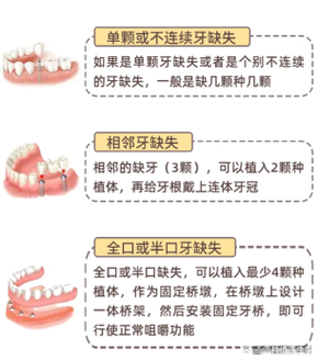 种植牙取冠的具体操作步骤是怎样的？需要哪些专业工具和注意事项？术后如何正确护理牙冠？-图2