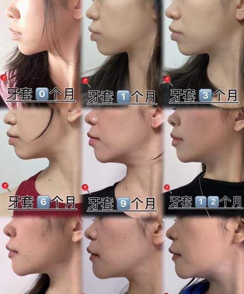 牙性龅牙正畸前后对比，矫正后牙齿排齐和侧脸改善真的能同步实现吗？矫正期间有哪些关键注意事项？-图2