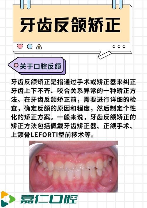 矫正颌骨正牙方法有哪些？不同术式适用人群、效果及风险该如何科学选择？-图3