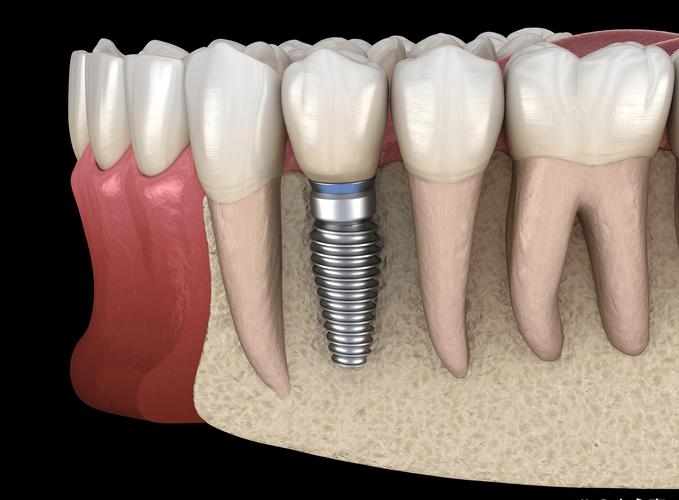 种植牙到底好不好？效果持久吗？有啥风险？哪些人适合？看完这些再决定！-图3
