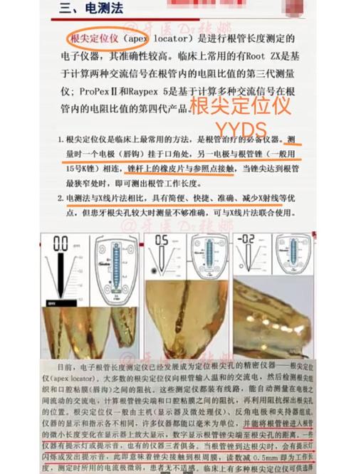 当前临床常用的根管长度测量方法有哪些？不同方法的准确性及适用场景如何选择？-图1