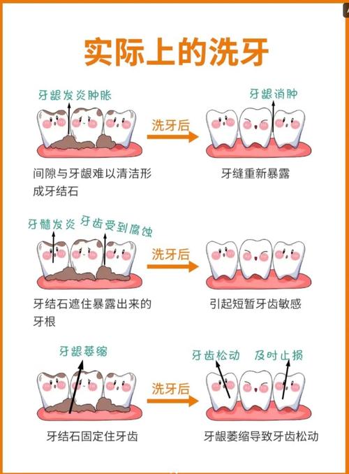 在口腔修复临床操作中,常用的排龈方法有哪些?不同方法的具体操作步骤、适应症及注意事项分别是什么?-图2 在口腔修复临床操作中,常用的排龈方法有哪些?不同方法的具体操作步骤、适应症及注意事项分别是什么?-图2