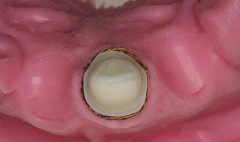 在口腔修复临床操作中,常用的排龈方法有哪些?不同方法的具体操作步骤、适应症及注意事项分别是什么?-图1 在口腔修复临床操作中,常用的排龈方法有哪些?不同方法的具体操作步骤、适应症及注意事项分别是什么?-图1