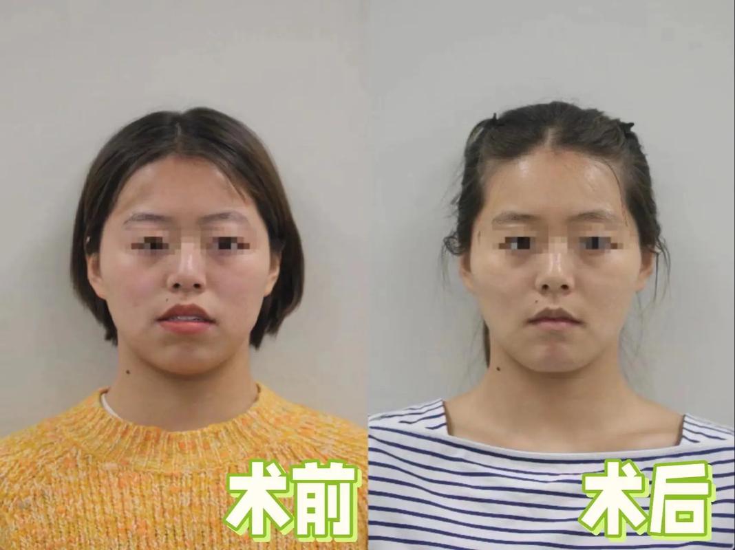 正畸联合正颌手术失败-图3 正畸联合正颌手术失败-图3