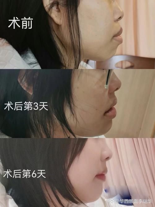 正畸联合正颌手术失败-图2