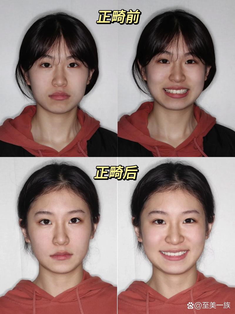 正畸面像拍摄技巧图片中，如何规范操作以获取清晰、全面的诊断影像？-图2