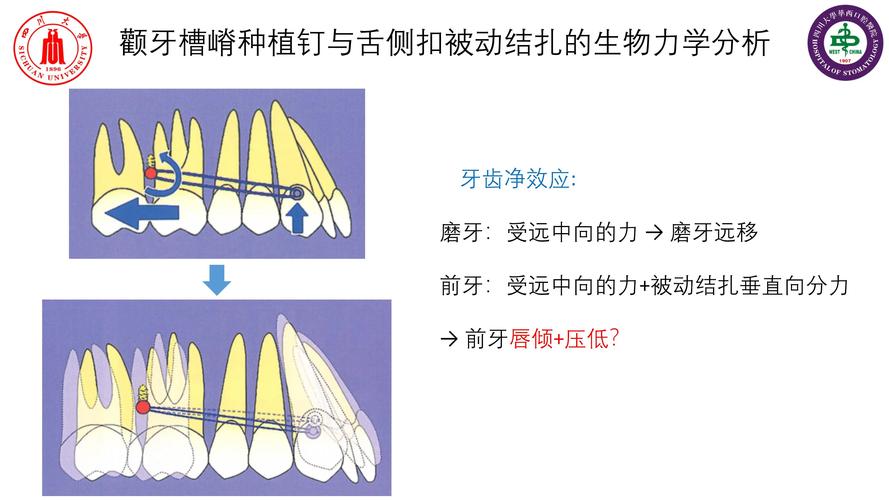 正畸牙移动的力学原理究竟如何通过不同矫治力实现牙齿的精准生理性移动？-图3
