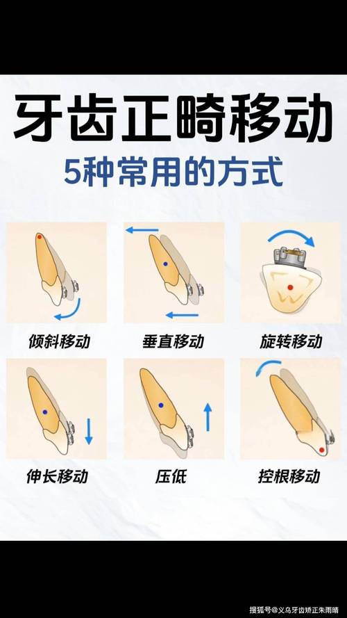 正畸牙移动的力学原理究竟如何通过不同矫治力实现牙齿的精准生理性移动？-图2