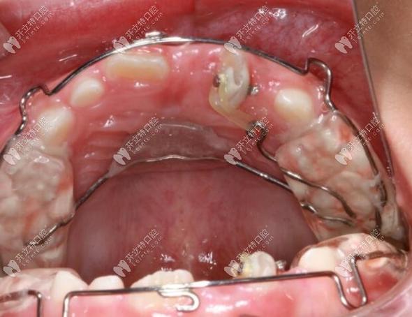 牙齿扭转矫正正畸有哪些方法？不同矫正方式的效果、时间、费用及注意事项是什么？-图2