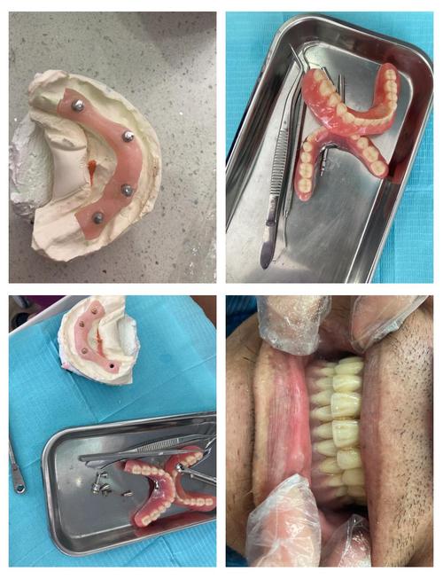 拜尔种牙的实际效果究竟如何？口碑和性价比靠谱吗？有没有需要注意的坑？-图3