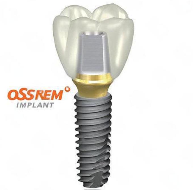 奥齿泰和登腾种植牙到底怎么选?从价格、耐用性到医生适配性全面对比哪个更值得入手?-图3 奥齿泰和登腾种植牙到底怎么选?从价格、耐用性到医生适配性全面对比哪个更值得入手?-图3