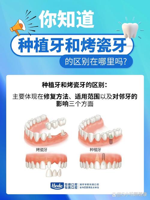 已经做过烤瓷牙的人,是否还能进行种植牙修复?有哪些注意事项和潜在影响需要考虑?-图2 已经做过烤瓷牙的人,是否还能进行种植牙修复?有哪些注意事项和潜在影响需要考虑?-图2