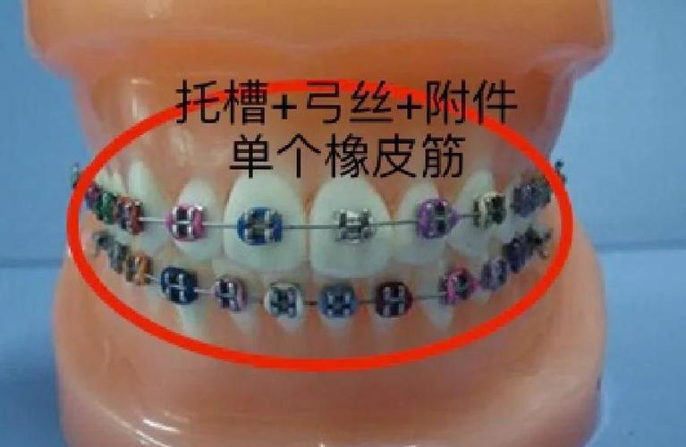 长沙天天正畸托槽图谱详细介绍了哪些托槽类型，对正畸患者选择托槽有何实际指导意义？-图2