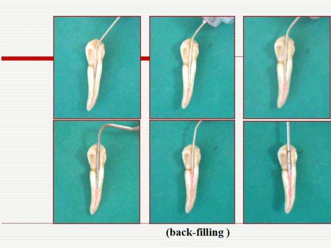 根管充填不同方法(如冷牙胶侧压、热牙胶垂直加压等)的临床效果与并发症发生率有何差异?如何根据患牙情况选择最优方案?-图1 根管充填不同方法(如冷牙胶侧压、热牙胶垂直加压等)的临床效果与并发症发生率有何差异?如何根据患牙情况选择最优方案?-图1