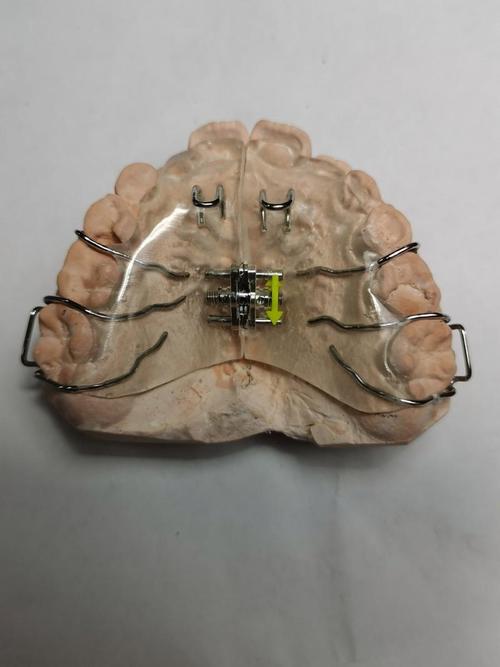 正畸戴螺旋簧是什么感觉?牙齿会有酸胀疼吗?多久能适应这种矫治力?-图1 正畸戴螺旋簧是什么感觉?牙齿会有酸胀疼吗?多久能适应这种矫治力?-图1