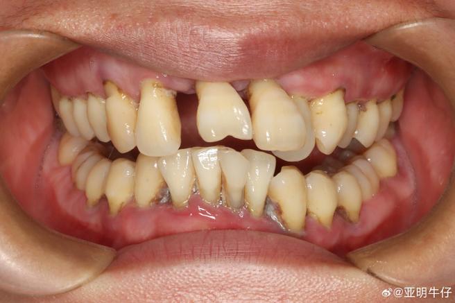 种牙二期后后牙松动是什么原因导致的？需要立即处理吗？会不会影响种植牙的长期使用寿命？-图1