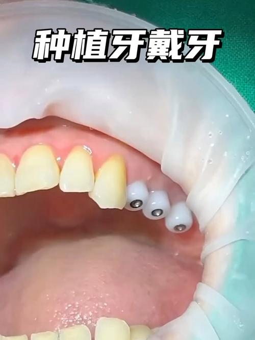 种牙二期后后牙松动是什么原因导致的？需要立即处理吗？会不会影响种植牙的长期使用寿命？-图2