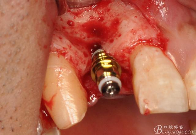 种牙摘钛网的具体过程是怎样的?手术中会有明显疼痛感吗?术后多久能恢复正常饮食?-图2 种牙摘钛网的具体过程是怎样的?手术中会有明显疼痛感吗?术后多久能恢复正常饮食?-图2