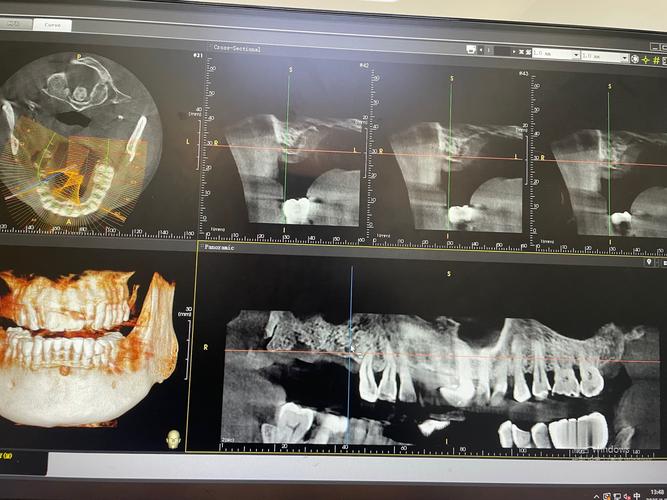 种牙拆线时间因人而异吗？一般术后几天需要拆线，影响因素有哪些？-图2