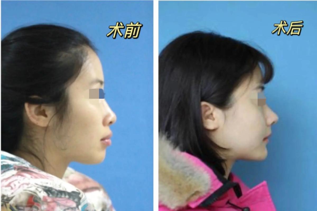 九院正颌真的不管正畸吗？正颌前必须先做正畸吗？两者治疗该如何衔接？-图3