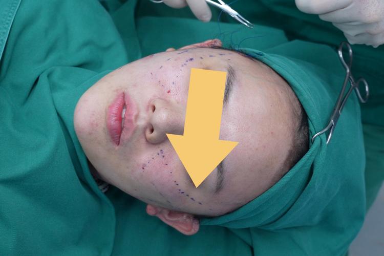 牙周内斜切口方法在牙周翻瓣术中如何精准操作以减少组织损伤?其临床适应症选择及术后长期效果评估标准是什么?-图1 牙周内斜切口方法在牙周翻瓣术中如何精准操作以减少组织损伤?其临床适应症选择及术后长期效果评估标准是什么?-图1