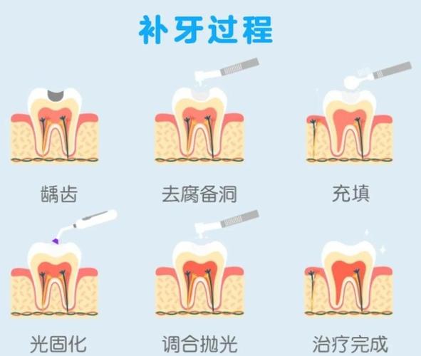 补假牙目前有哪些常见修复方法?不同方法分别适合哪些缺牙情况?-图3 补假牙目前有哪些常见修复方法?不同方法分别适合哪些缺牙情况?-图3