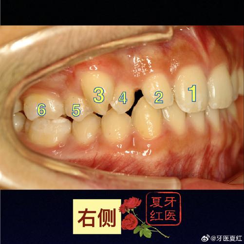 正畸前测量牙弓拥挤度时，哪些关键指标会影响矫正效果？不精准测量会导致哪些常见问题？-图3