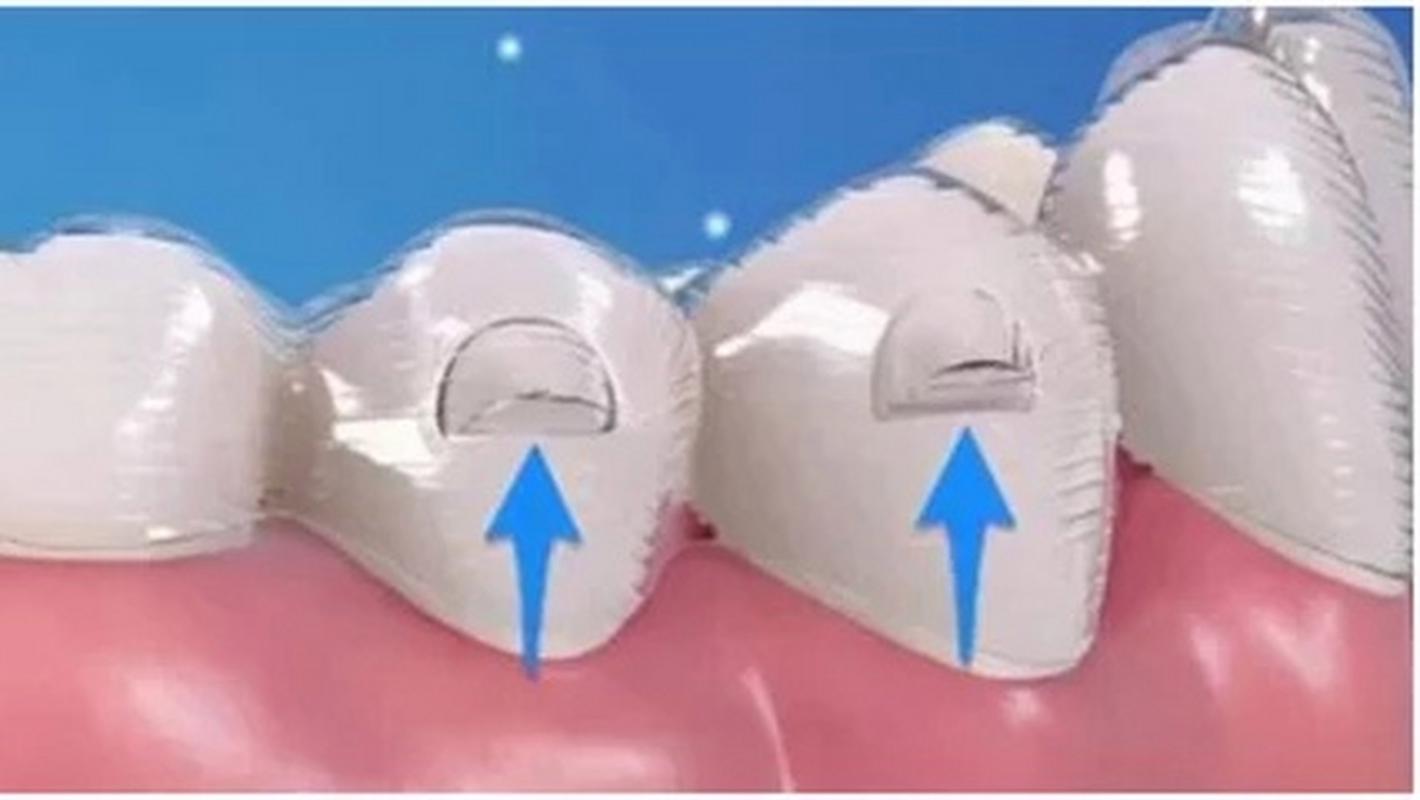 隐形正畸附件到底是什么?它在牙齿矫正中具体能发挥哪些作用?材质和设计有什么特别之处?-图2 隐形正畸附件到底是什么?它在牙齿矫正中具体能发挥哪些作用?材质和设计有什么特别之处?-图2