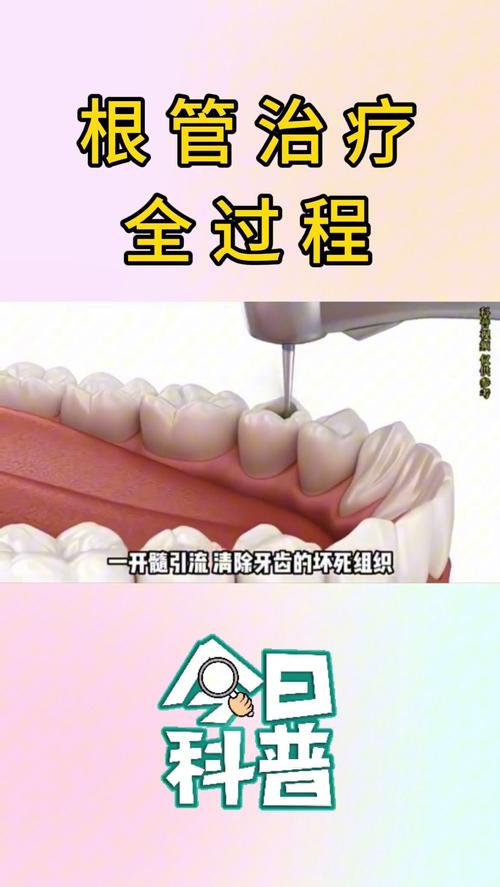 弯根根管治疗有哪些难点?不同弯曲程度的根管应如何选择安全有效的治疗方法?-图2 弯根根管治疗有哪些难点?不同弯曲程度的根管应如何选择安全有效的治疗方法?-图2