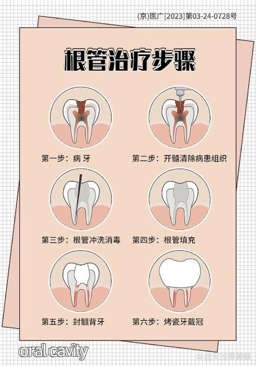 弯根根管治疗有哪些难点?不同弯曲程度的根管应如何选择安全有效的治疗方法?-图1 弯根根管治疗有哪些难点?不同弯曲程度的根管应如何选择安全有效的治疗方法?-图1