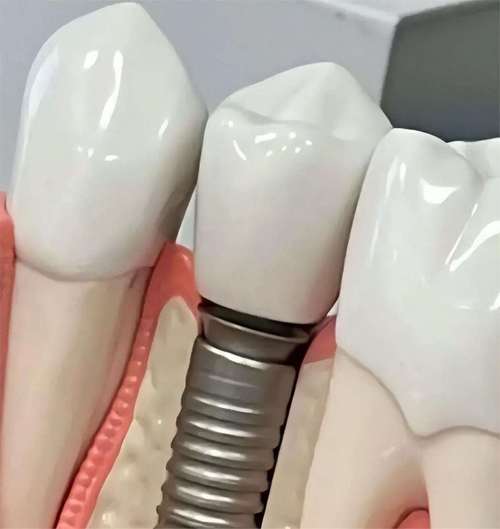 成都种牙为何选圣贝？其巨优口碑背后藏着哪些技术与服务优势？-图3