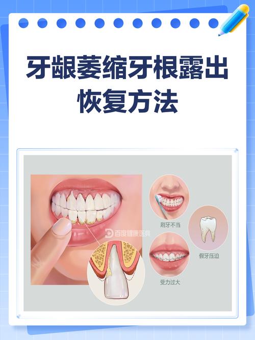牙周自我修复方法真的存在吗?日常有哪些具体步骤能科学促进牙周健康恢复?-图1 牙周自我修复方法真的存在吗?日常有哪些具体步骤能科学促进牙周健康恢复?-图1