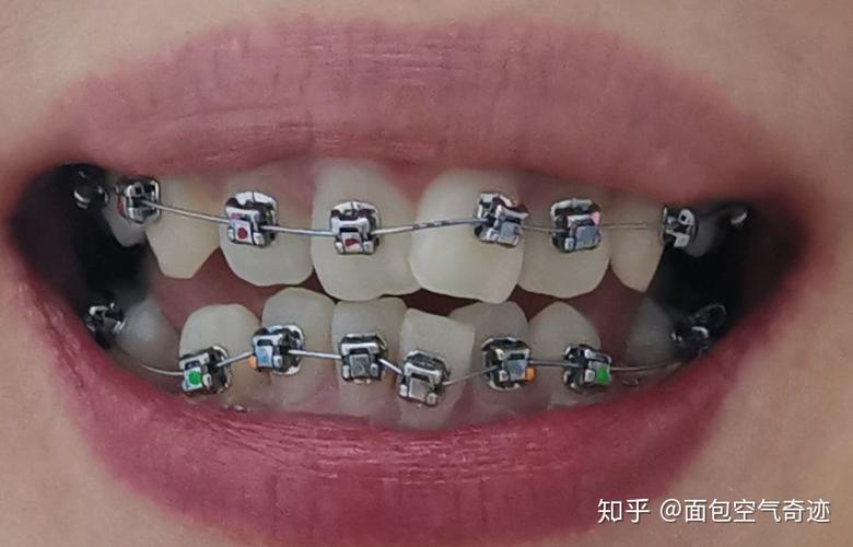 广州光华口腔医院正畸效果真的靠谱吗?不同年龄做正畸有什么区别?技术设备和医生团队如何保障效果?-图1 广州光华口腔医院正畸效果真的靠谱吗?不同年龄做正畸有什么区别?技术设备和医生团队如何保障效果?-图1