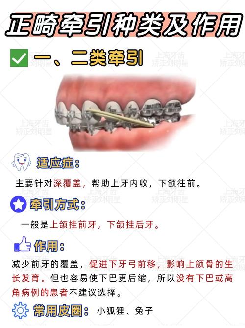 牙科正畸牵引圈的具体用法是什么？不同牙齿错颌畸形如何选择牵引方式？操作步骤和常见误区有哪些？-图1
