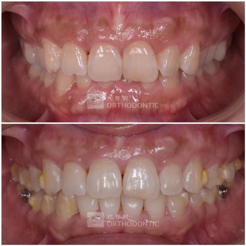 李树军与代育桐在正畸领域的技术方向有何不同?患者该如何根据牙齿问题选择合适的医生?-图3 李树军与代育桐在正畸领域的技术方向有何不同?患者该如何根据牙齿问题选择合适的医生?-图3