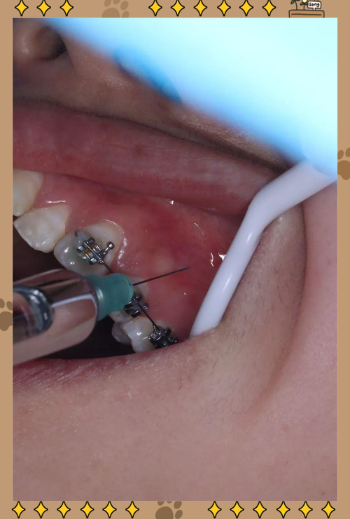 正畸治疗中上下左右对称拔牙是必须遵循的原则吗？这种拔牙方式对不同错颌类型的矫正效果有何具体影响？-图2