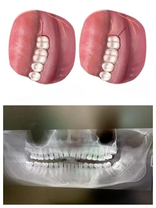 后牙拔髓的具体操作步骤有哪些?不同根管形态下使用方法有何注意事项?-图2 后牙拔髓的具体操作步骤有哪些?不同根管形态下使用方法有何注意事项?-图2