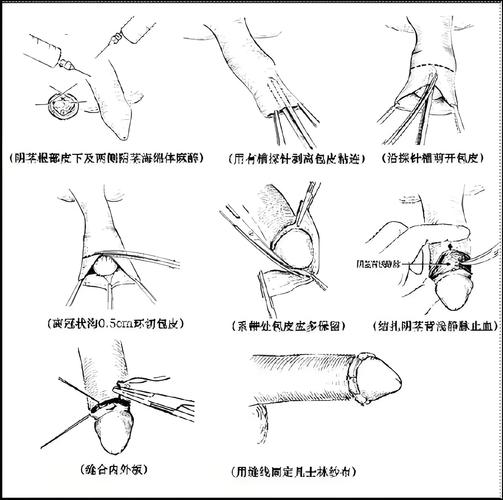 分根术的手术方法具体如何操作?不同适应症下的关键步骤、技术细节及术后注意事项有哪些?-图2 分根术的手术方法具体如何操作?不同适应症下的关键步骤、技术细节及术后注意事项有哪些?-图2
